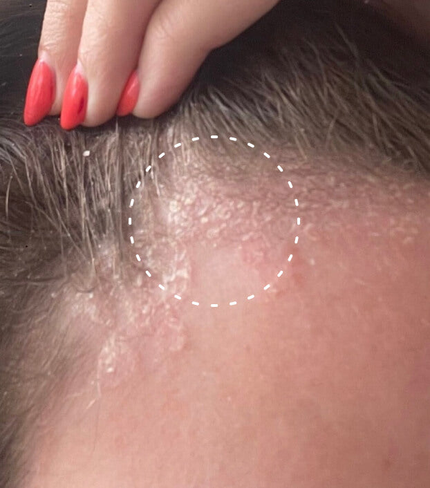Image of a person with psoriasis on their scalp line
